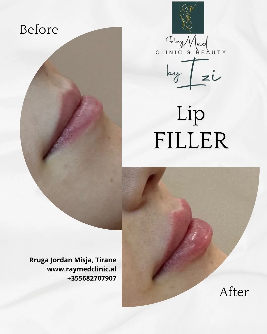 Lip Filler Before & After